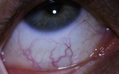 Gluten Intolerance – Sclerology